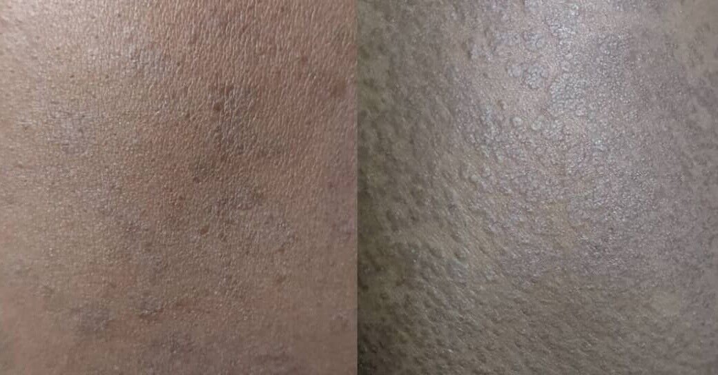 النخالية المبرقشة (Pityriasis Versicolor) — قبل وبعد العلاج
